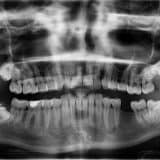 Exams and X-Ray Hudson Dental Center