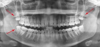 Wisdom Tooth Extraction at Hudson Dental Center in West New York, NJ