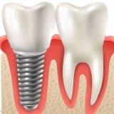 Dental Implants in West New York