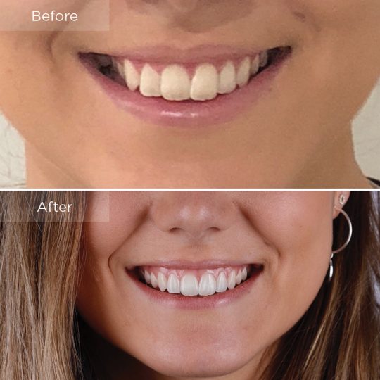 Invisalign After Before Case 1