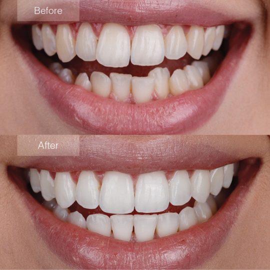 Invisalign After Before Case 3
