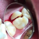 BROKEN OR CHIPPED TOOTH
