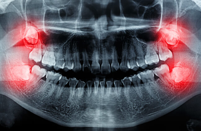 Wisdom Tooth Extraction in West New York
