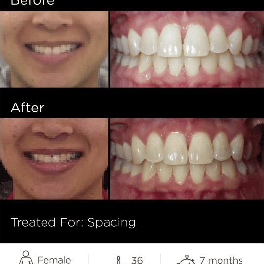 SS Case Study Case  BeforeAfter vb x