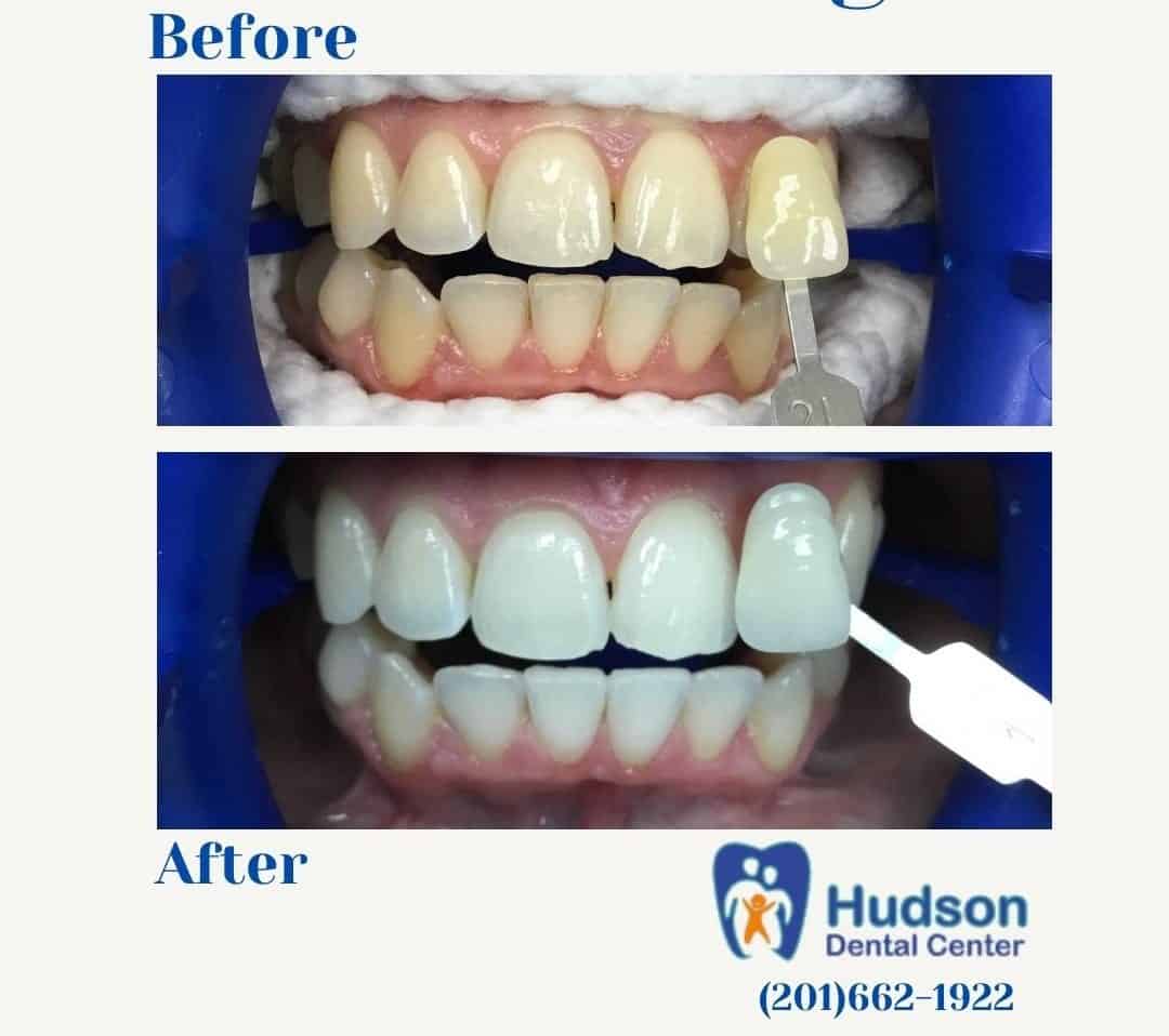 Smile Gallery - Teeth Whitening - Before & After
