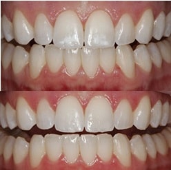 White Spot Removal - Before After