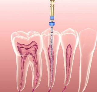 Endodontist In West New York