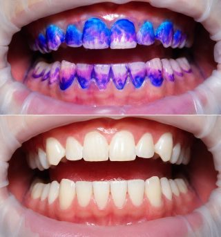Biofilm Therapy Before After